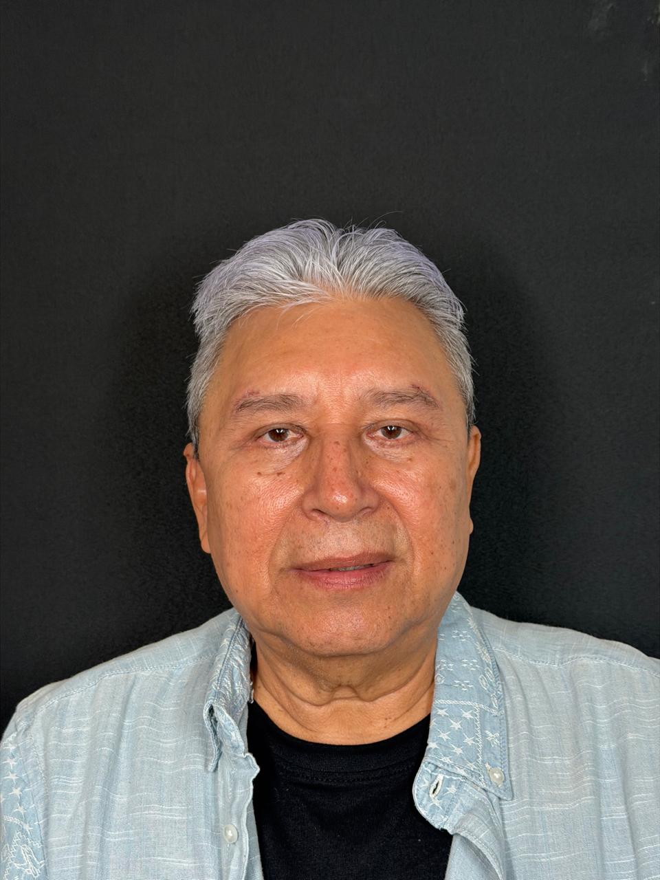 Antes blefaroplastia caso 2